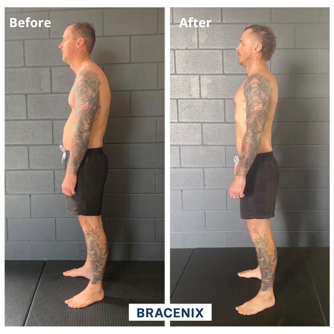 Bracenix™ Posture Corrector Brace